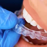 Benefits of Dental Aligners: A Comprehensive Guide