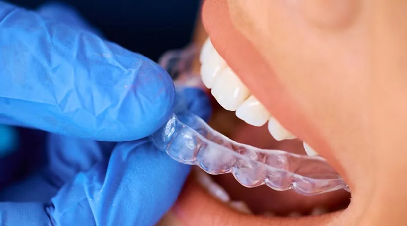 Benefits of Dental Aligners: A Comprehensive Guide